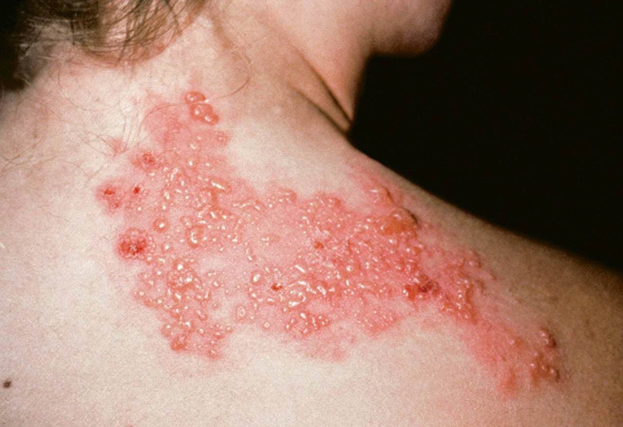 Groepjes gordelroosblaasjes met roodheid over de nek en schouder