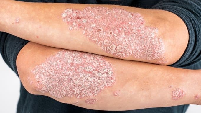 Rode dikke psoriasisplaques met zilverachtige schilfers op beide onderarmen en ellebogen.