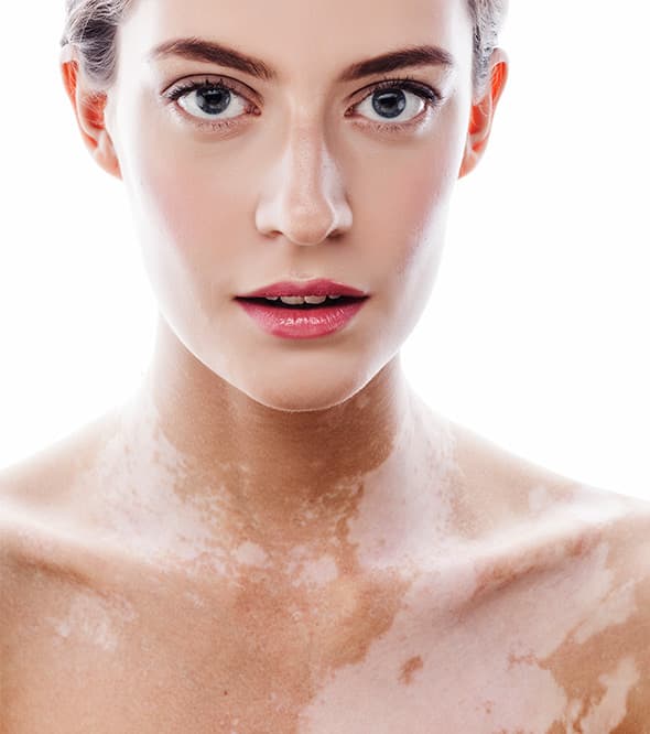 Bleke gepigmenteerde vlekken op de hals en borst van een vrouw, kenmerkend voor vitiligo.