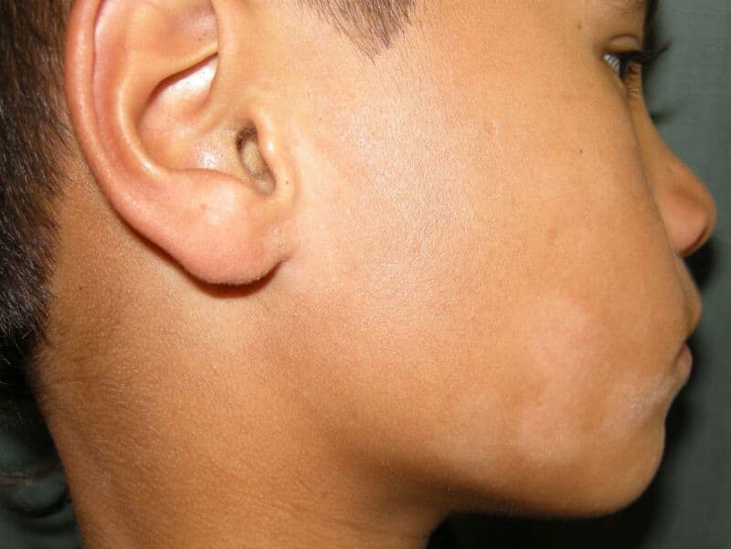 Bleke gehypopigmenteerde plek op de wang van een kind, kenmerkend voor pityriasis alba.